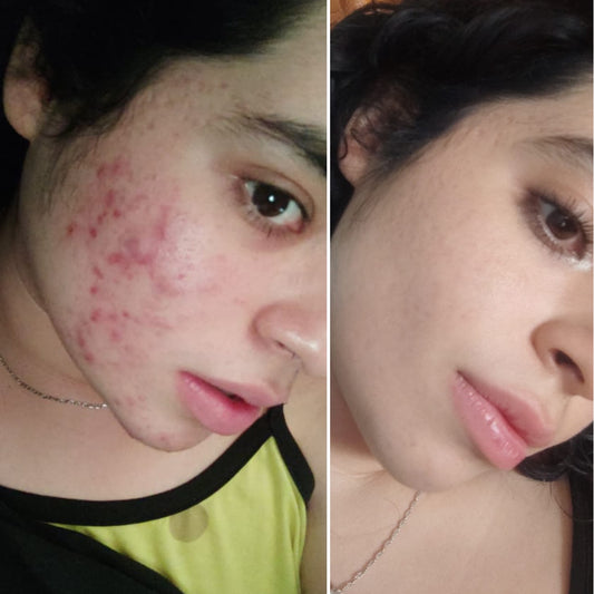 Tratamiento anti acné plan semestral